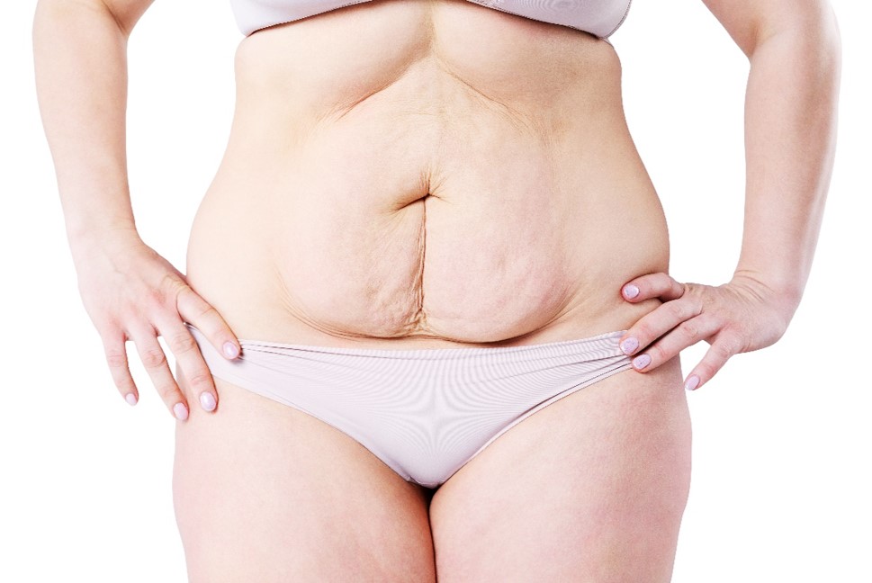 Abdominoplastia